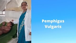 PEMPHIGUS VULGARIS Marathi pemphigus vulgaris treatment DR SMITA CHAKOTE [upl. by Weissman760]