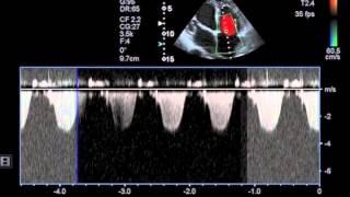 Myocarditis [upl. by Adia]