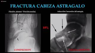 TRAUMATOLOGIA Fractura de astrágalo y calcáneo 8 de junio [upl. by Ahsinan]