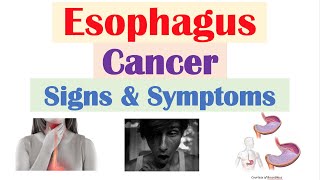 Esophageal Cancer Signs amp Symptoms amp Why They Occur [upl. by Eilhsa]