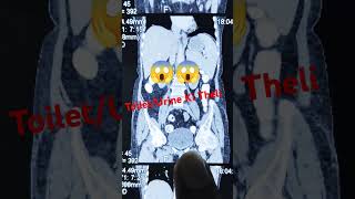 Urinary bladder Show In CT Scan radiology reels shortvideo shorts trending trendingshorts [upl. by Obla]