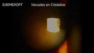 REMEXOPT Vacuolas en Cristalino [upl. by Adeirf]