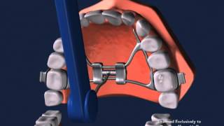 Advanced Orthodontics  Expanders [upl. by Dosi557]