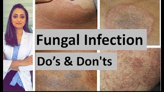 Fungal infection of skin  Dos and Donts  Dermatologist  Dr Aanchal Panth [upl. by Itirp]