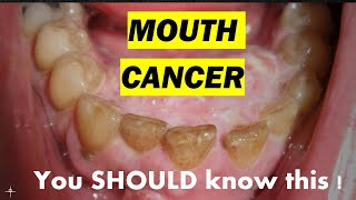 MOUTH CANCER  Symptoms  risk factors  prevention [upl. by Aitetel920]