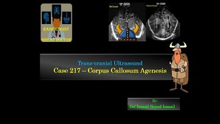 Ultrasound Case 217  Corpus Callosum Agenesis [upl. by Xineohp93]