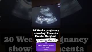 20 Weeks Pregnancy showing Placenta Previa On Ultrasound [upl. by Nirrac785]