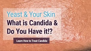 Yeast affecting your skin You may have it and not know Candida Albicans [upl. by Dunning]