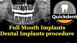 Full mouth Implants Case Step by Step Quickdent Dental implant Procedure  one drill TPR amp Ossi [upl. by Lipman]