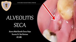 Semana 08 Alveolitis seca [upl. by Oderfliw]