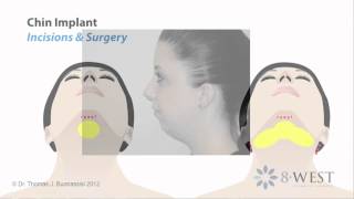 Part 213 Neck Liposuction amp Chin Implant  Face amp Neck Reshaping Surgery with Dr Buonassisi [upl. by Derreg650]