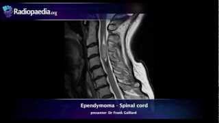 Spinal ependymoma  radiology video tutorial MRI [upl. by Natsyrk]