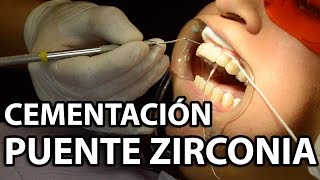 Cementación Puente Zirconia 6 Unidades👅Parte2 [upl. by Beauchamp149]