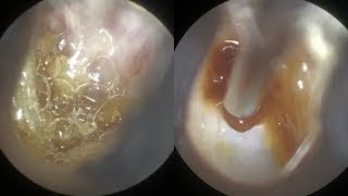 Impacted Ear Wax RemovalEP7  NN Ear cleaning [upl. by Champ]