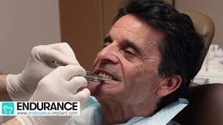 Prothèse amovible  Travail du dentiste et prothésiste  Dr SUBA Hongrie [upl. by Heimlich]