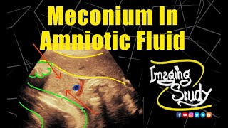 Meconium in Amniotic Fluid  Ultrasound  Case 314 [upl. by Nefets]