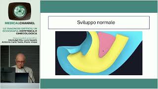 Estrofia della vescica Segni ecografici e difficoltà diagnostiche  P Volpe [upl. by Slerahc]