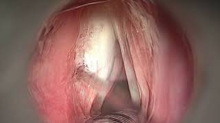 PHONOSURGERY  LEFT VOCAL FOLD PALSY [upl. by Avilla]