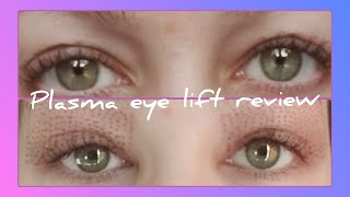 plasma fibroblast eye lift review  mid way through treatment [upl. by Signe542]