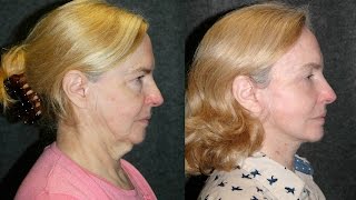 New Facelift Procedure S Lift  Deep Plane Facelift Before and After 65 YO Woman bestnycfacelift [upl. by Odrautse]