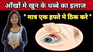 Sub Cunjuctiva Hemorrhage Treatment  Ankho Me khun ke Lal Dhabbe Ka Ilaz  In Hindi [upl. by Lucas]