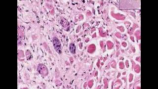 Histopathology TongueSquamous cell carcinoma [upl. by Stephi]