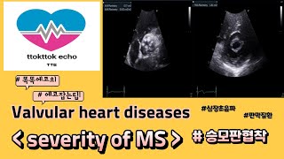 승모판협착 중증도 평가 mitral stenosis severity echocardiography 심장초음파 heart echo view 판막질환 승모판협착 [upl. by Nebeur265]