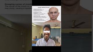 Bells Palsy patients improvement during physiotherapy  shorts physio  bells Palsy [upl. by Elonore]