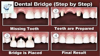 Dental Bridge Procedure Step by Step [upl. by Kroo]