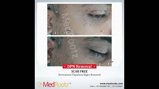 Dermatosis Papulosa Nigra Removal  Best Laser Treatment For DPN  DrAnujSaigal​​  MedRootz [upl. by Annahavas400]