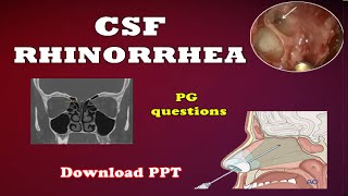 CSF RHINORRHEA  ENT  Easy explanation  All you need to know [upl. by Pegma]