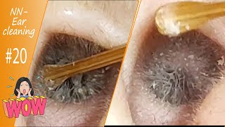 Impacted Ear Wax RemovalEP20 NN Ear cleaning [upl. by Alisun511]