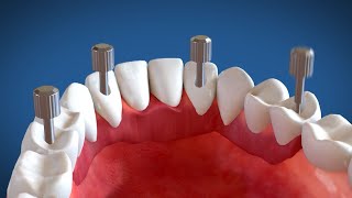 Video Animazione 3D Implantologia dentale a carico immediato Sistema Modulabile [upl. by Amitak]