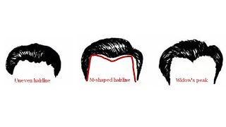 Which Hairline Do You Have [upl. by Robbie]