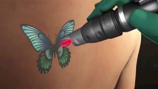 Eliminación de tatuajes con láser [upl. by Einahpad]