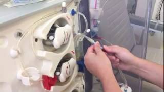 Dialysis twister measurement of arteriovenous fistula flow [upl. by Ecirtahs772]