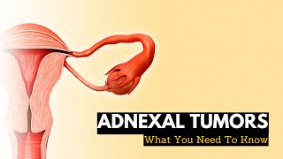 Adnexal Tumors What You Need To Know [upl. by Roshan]