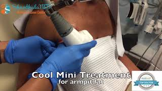 Cool Mini Coolsculpting Treatment for Armpit Fat [upl. by Pratte]