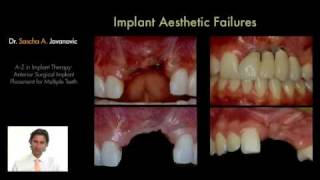 00208 Anterior Surgical Implant Placement Multiple Anterior Teeth PREVIEW [upl. by Candace]