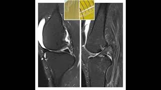 Gouty arthritis VS Degenerative arthritis [upl. by Lela]