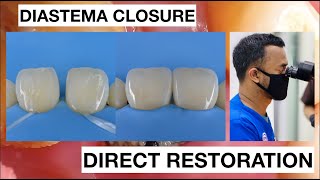 Diastema Closure with Direct Bonding Composite Restoration  General Dentist Griya RR [upl. by Tonya15]