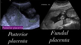 How to localise Placenta in ultrasound full video [upl. by Daye]