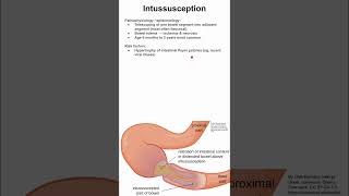 Intussusception [upl. by Onaled53]