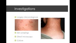 Pityriasis Versicolour  ruralflyingdoc [upl. by Viola524]