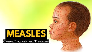 Measles Causes Signs and Symptoms Diagnosis and Treatment [upl. by Warila804]