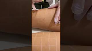 Tratamiento mesoterapía con draanaherraiz en Clínica Médico Estética Miriam Moreno mesoterapia [upl. by Eeluj]