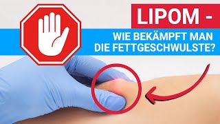 Lipom  wie bekämpft man die Fettgeschwulste [upl. by Shurlocke417]