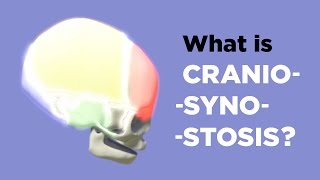 What is Craniosynostosis [upl. by Leohcin]