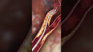 Carotid embolic prevention  animationshorts shortsfeed youtubeshorts viralshorts [upl. by Diao]