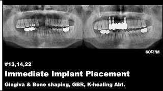 131422 Immediate Implant Placement Gingiva amp Bone shaping GBR Khealing Abt [upl. by Shute570]